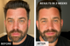 CraftedSkinClub Pro Men’s LED Face Mask